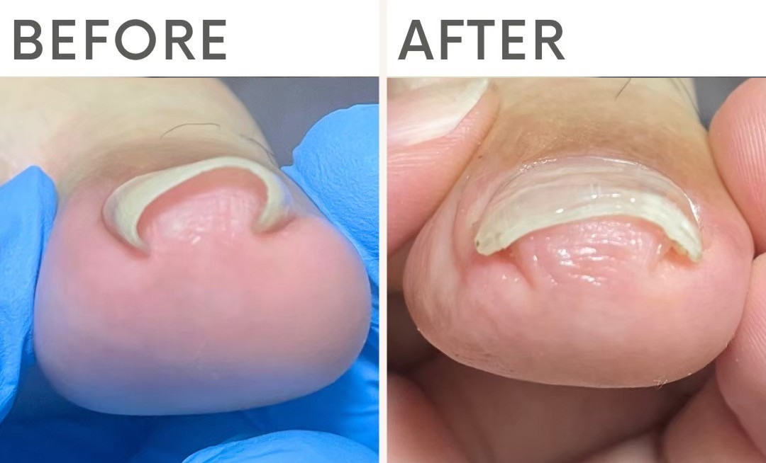 長年続いていた歩行時の痛みが、切らない巻き爪補正で軽減