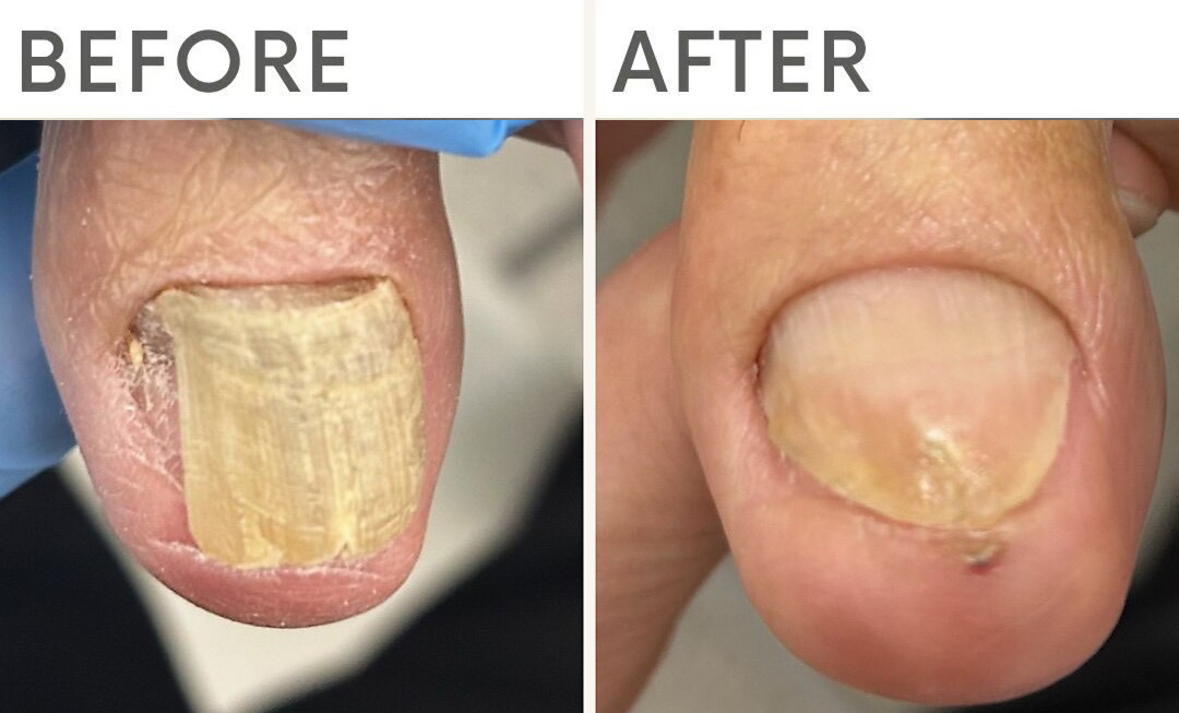 皮膚科でも対応が難しかった肥厚爪が、専門ケアで改善