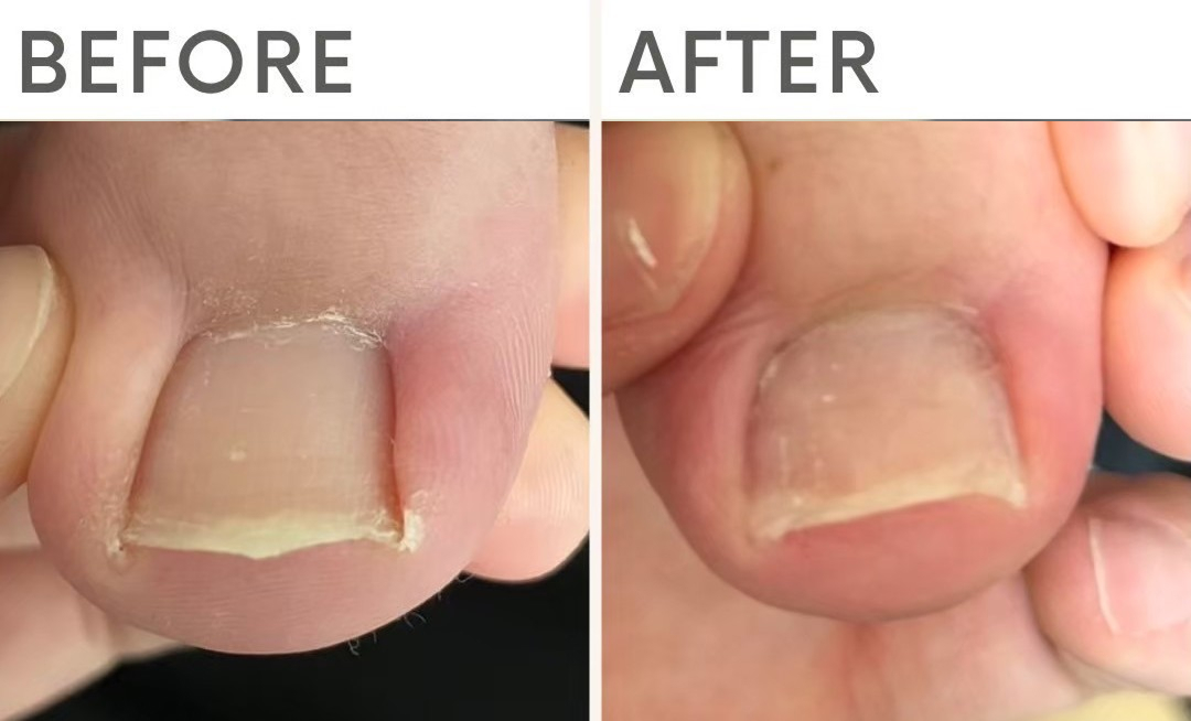 仕事による親指の痛みが改善し、ネイルを楽しめる足元へ