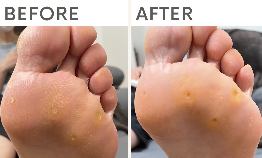 繰り返していた足裏の痛みが改善し、快適に歩けるように