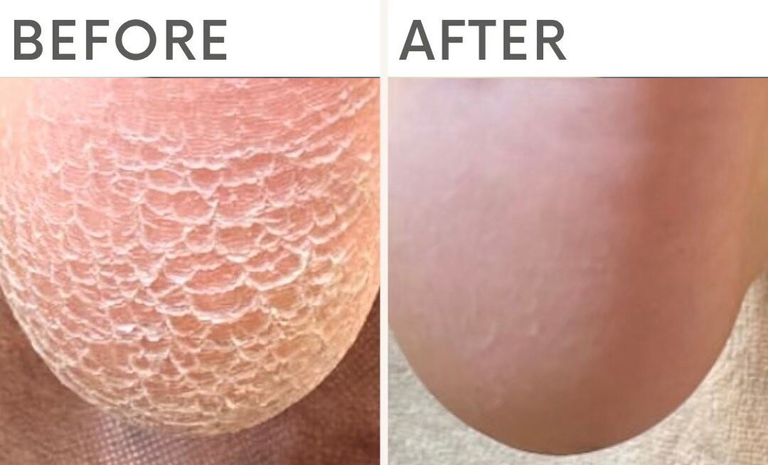 かかとのガサガサが改善し、なめらかな足元へ